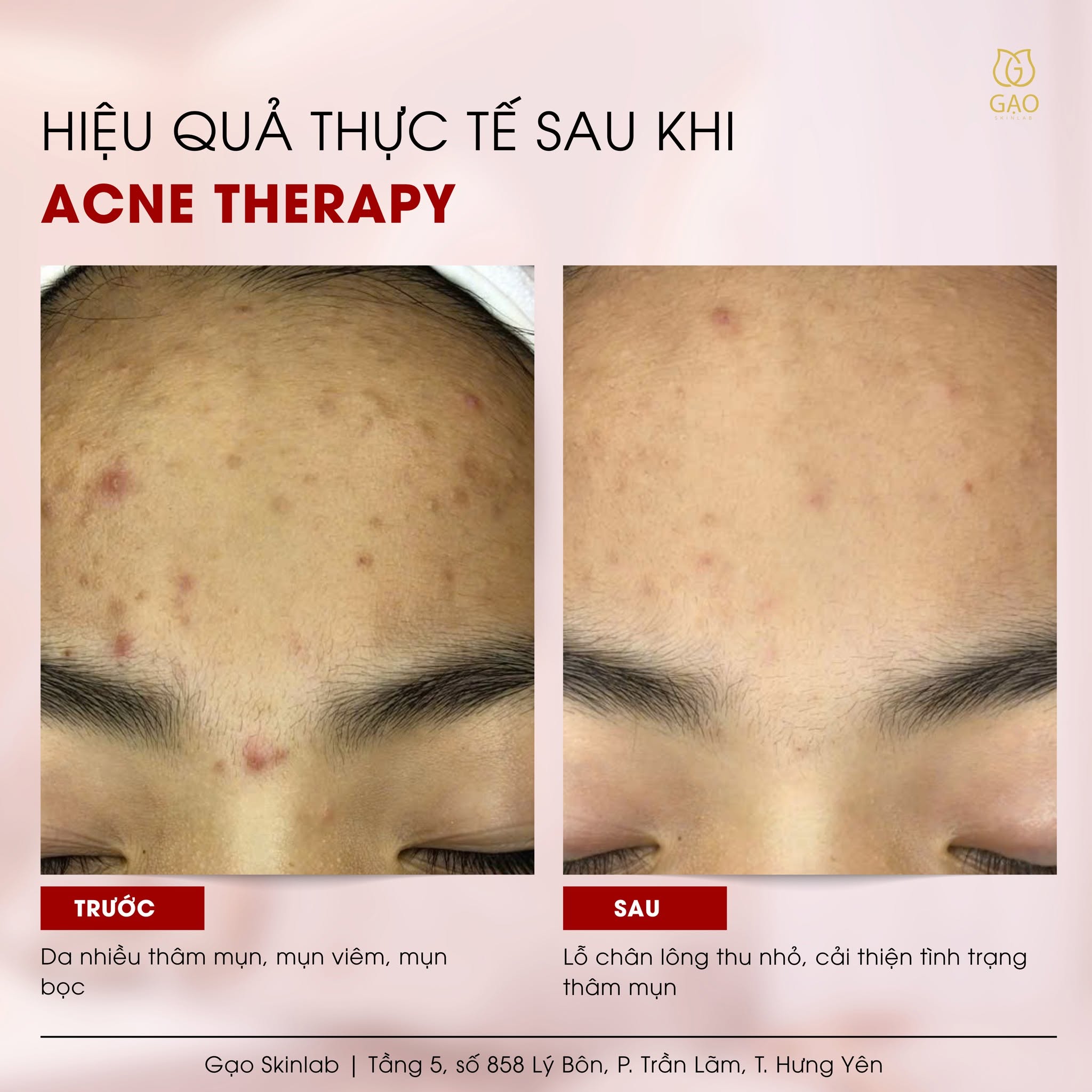 Ảnh ghép trước – sau vùng trán của Gạo Skinlab với tiêu đề Acne Therapy: bên trái da nhiều thâm mụn và mụn viêm, bên phải da sáng và đều hơn.