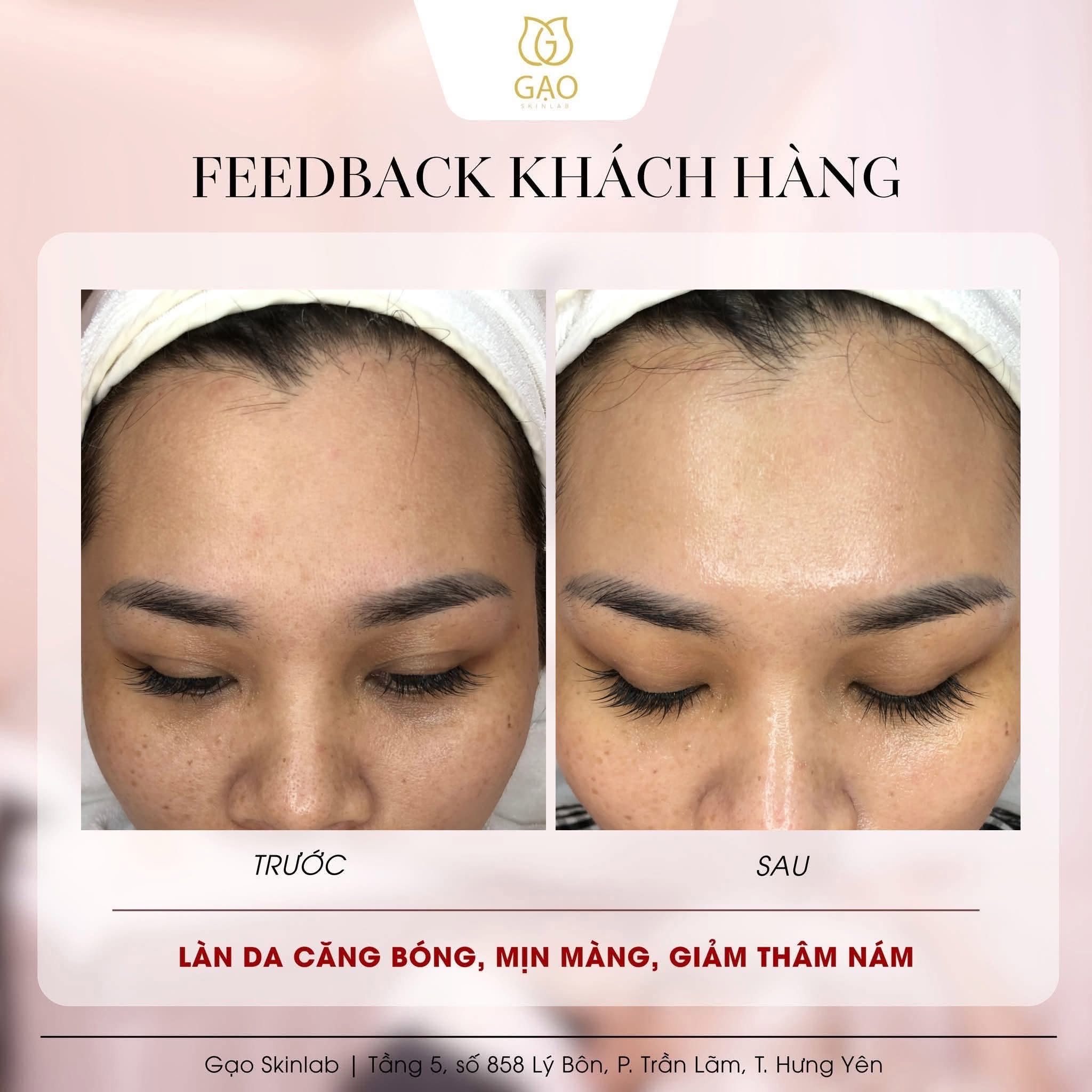 Ảnh ghép trước – sau vùng trán và mắt của Gạo Skinlab: bên trái ghi Trước, da hơi sần và kém tươi; bên phải ghi Sau, da căng bóng; dòng chữ dưới ảnh: Làn da căng bóng, mịn màng, giảm thâm nám.