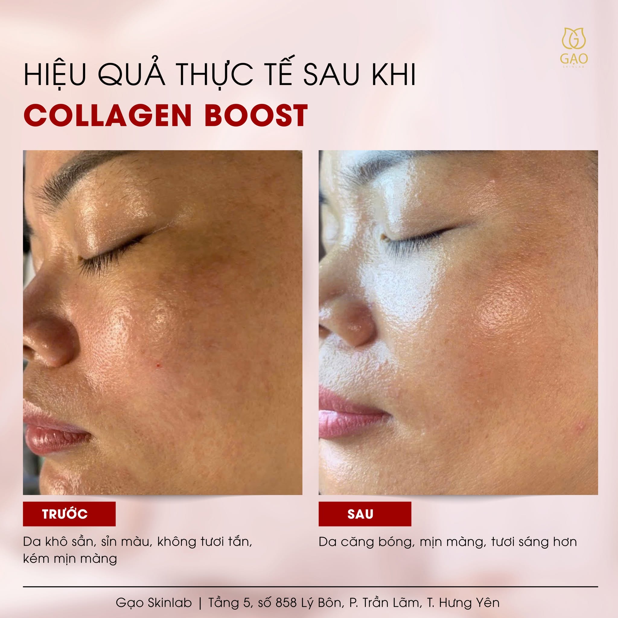 Ảnh ghép trước – sau góc nghiêng mặt của Gạo Skinlab với tiêu đề Collagen Boost: bên trái da khô sần, xỉn màu; bên phải da căng bóng, tươi sáng hơn.