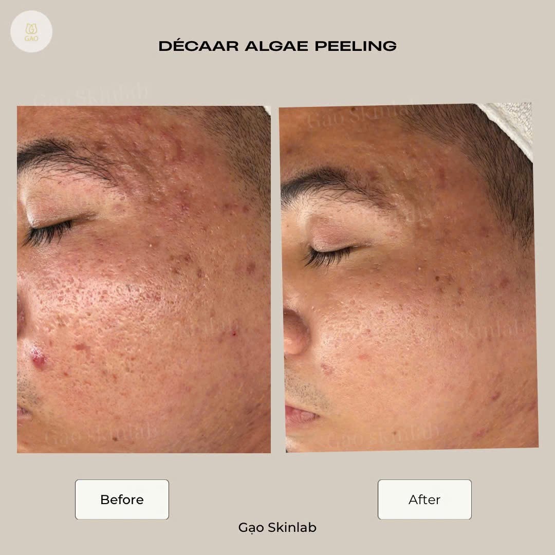 Ảnh ghép trước – sau vùng má và thái dương của Gạo Skinlab, tiêu đề Décaar Algae Peeling: bên trái ghi Before, da nhiều mụn viêm, sẹo và lỗ chân lông rõ; bên phải ghi After, nền da đều và mịn hơn.