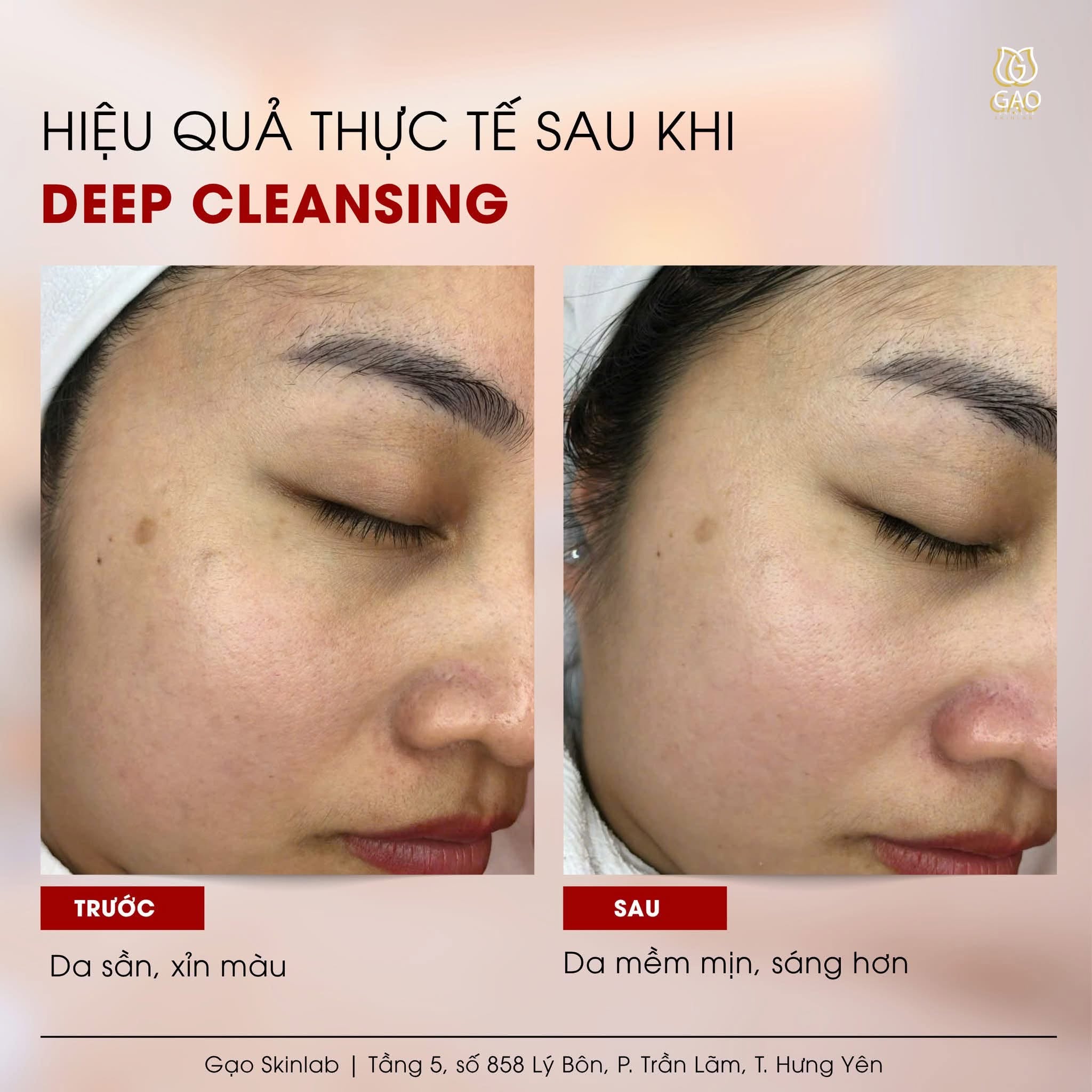 Ảnh ghép trước – sau góc nghiêng mặt của Gạo Skinlab với tiêu đề Deep Cleansing: bên trái da sần, xỉn màu; bên phải da mềm mịn, sáng hơn.