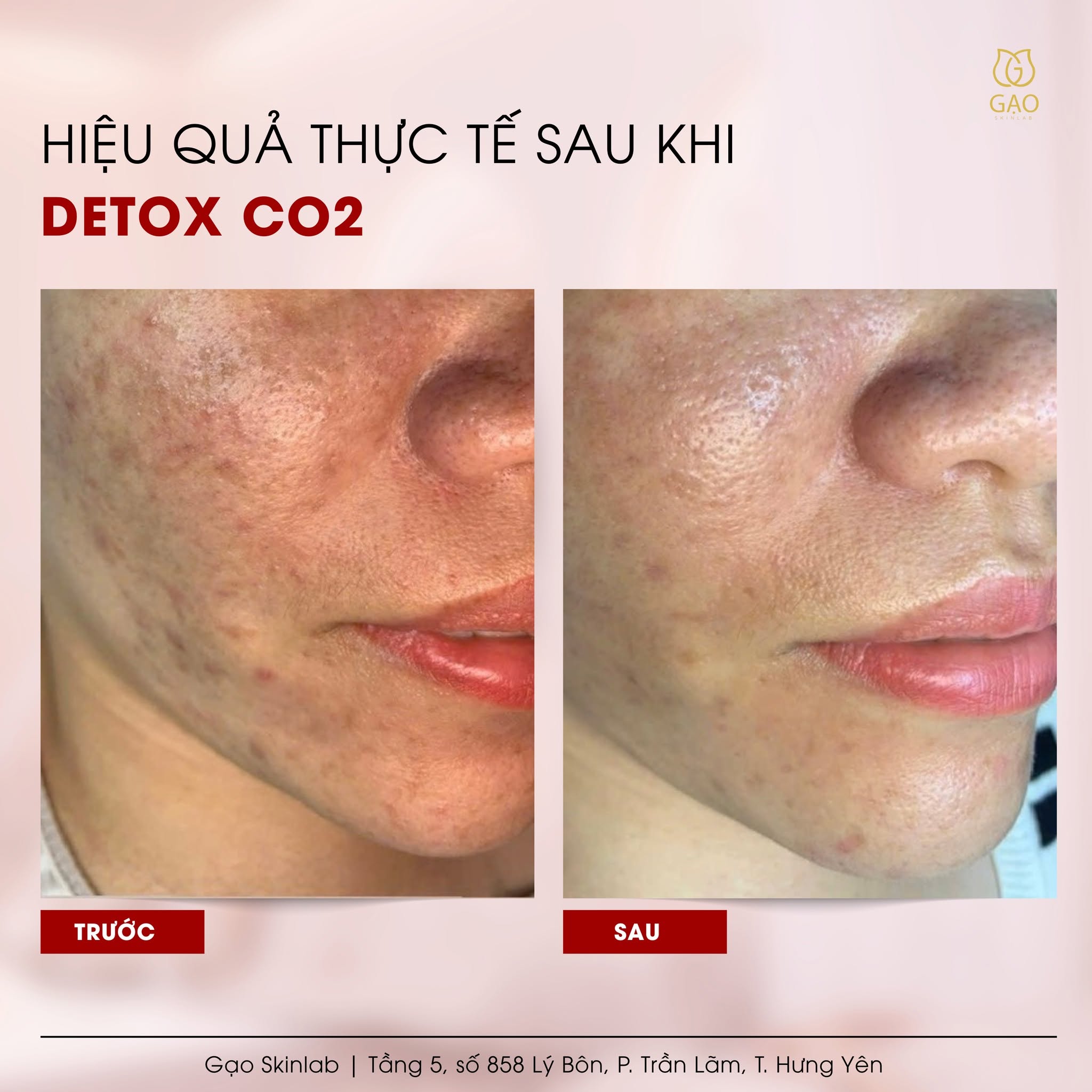 Ảnh ghép trước – sau vùng má và cằm của Gạo Skinlab với tiêu đề Hiệu quả thực tế sau khi Detox CO2: bên trái ghi Trước, bên phải ghi Sau.