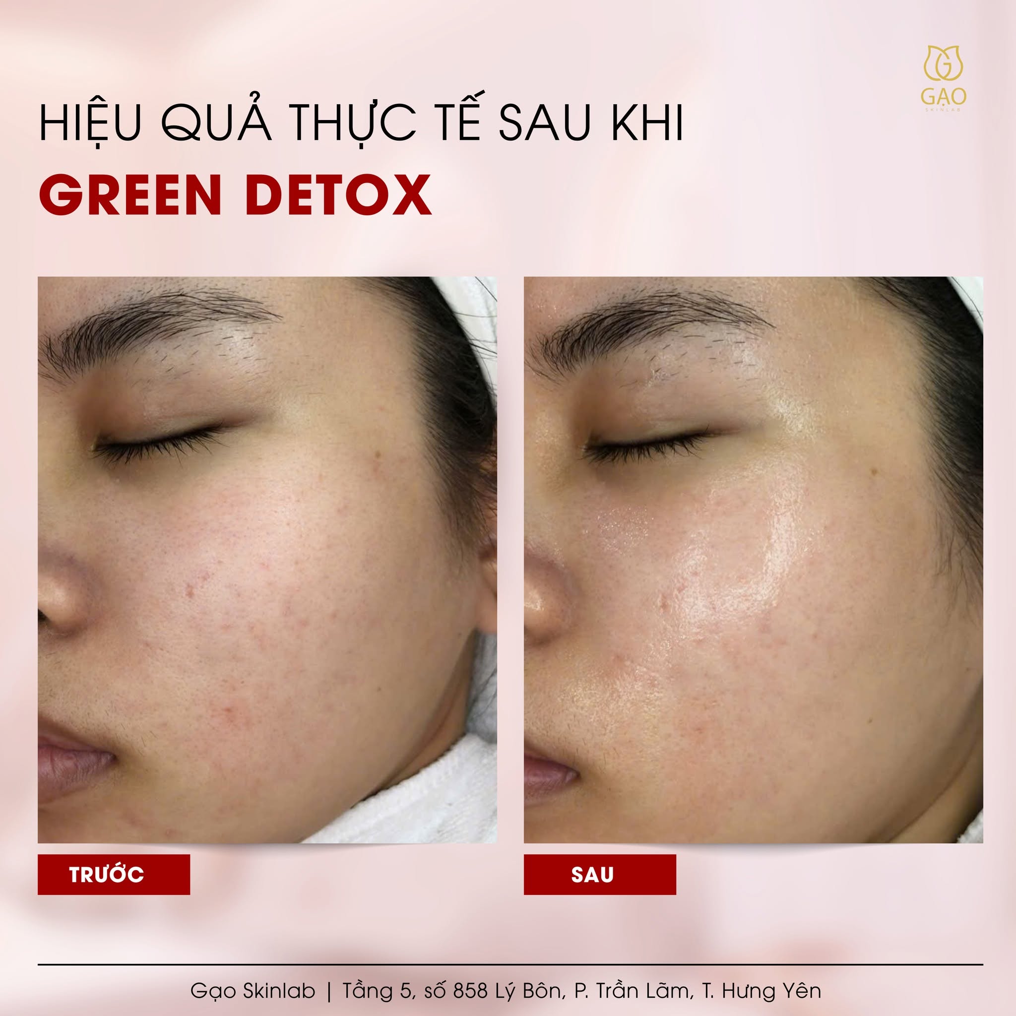 Ảnh ghép trước – sau vùng má của Gạo Skinlab với tiêu đề Hiệu quả thực tế sau khi Green Detox: bên trái ghi Trước, bên phải ghi Sau.