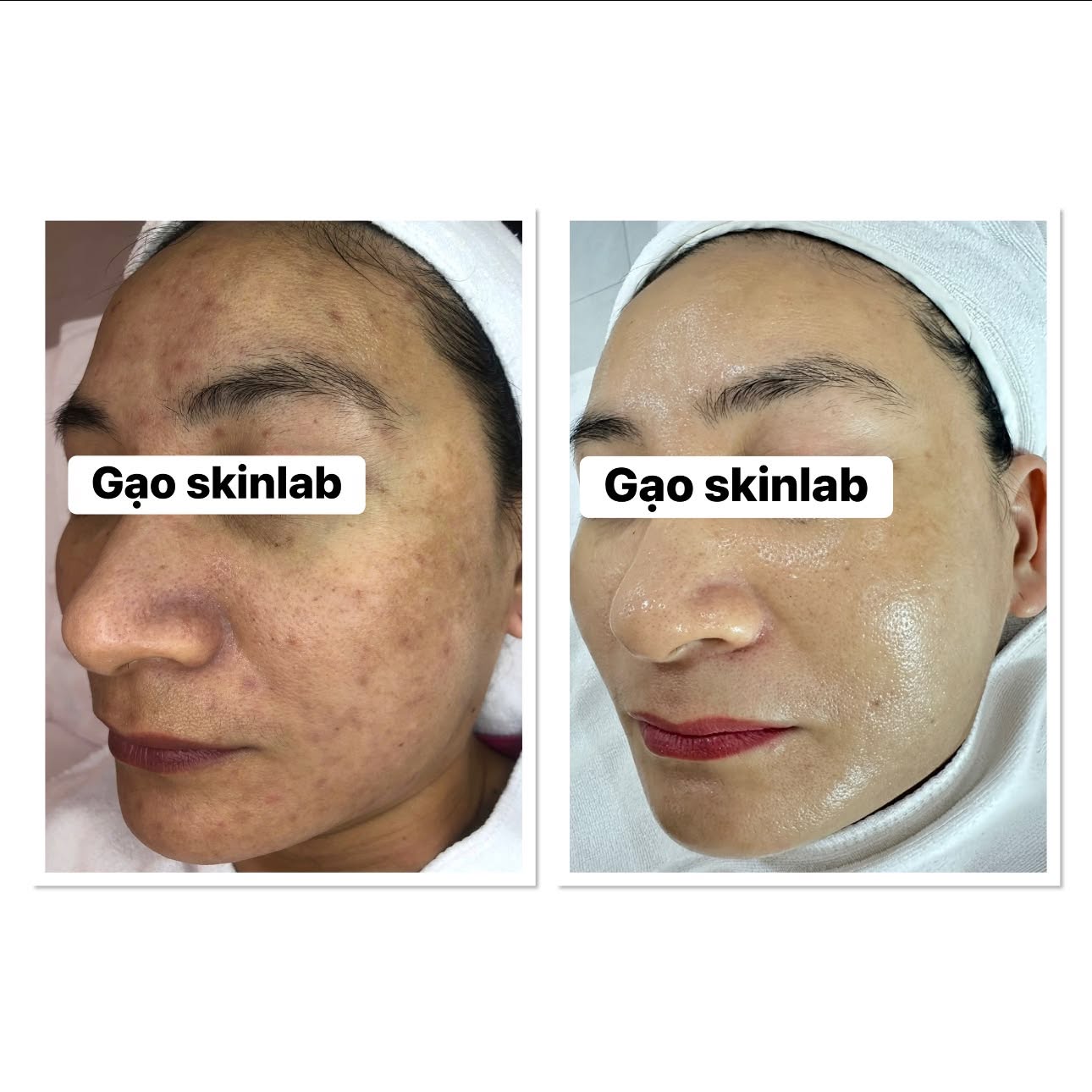 Ảnh ghép góc nghiêng mặt cùng một khách, có nhãn Gạo skinlab: bên trái má có nhiều đốm sắc tố và thâm; bên phải da đều màu và căng bóng hơn.