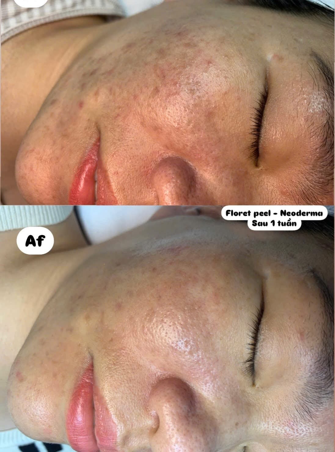 Ảnh ghép góc nghiêng má và mũi: ảnh trên là da trước, nhiều nốt mụn nhỏ và thâm; ảnh dưới ghi Af, da sáng và mịn hơn; nhãn: Floret peel – Neoderma, Sau 1 tuần.