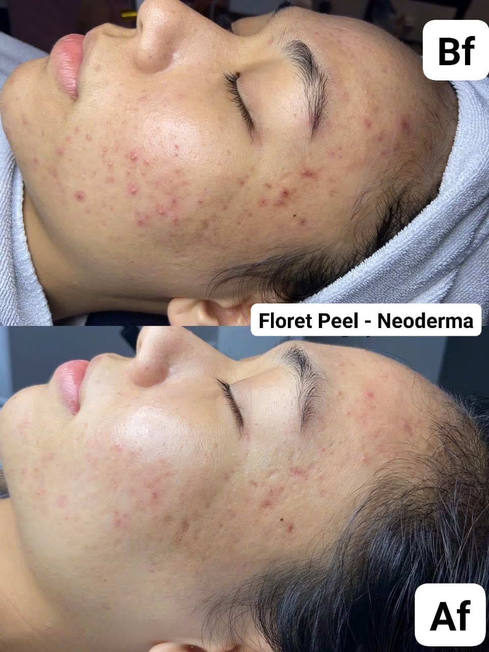 Ảnh ghép góc nghiêng mặt: ảnh trên ghi Bf, má và thái dương có nhiều nốt mụn đỏ; ảnh dưới ghi Af, nốt mụn nhạt hơn; nhãn giữa ảnh: Floret Peel – Neoderma.