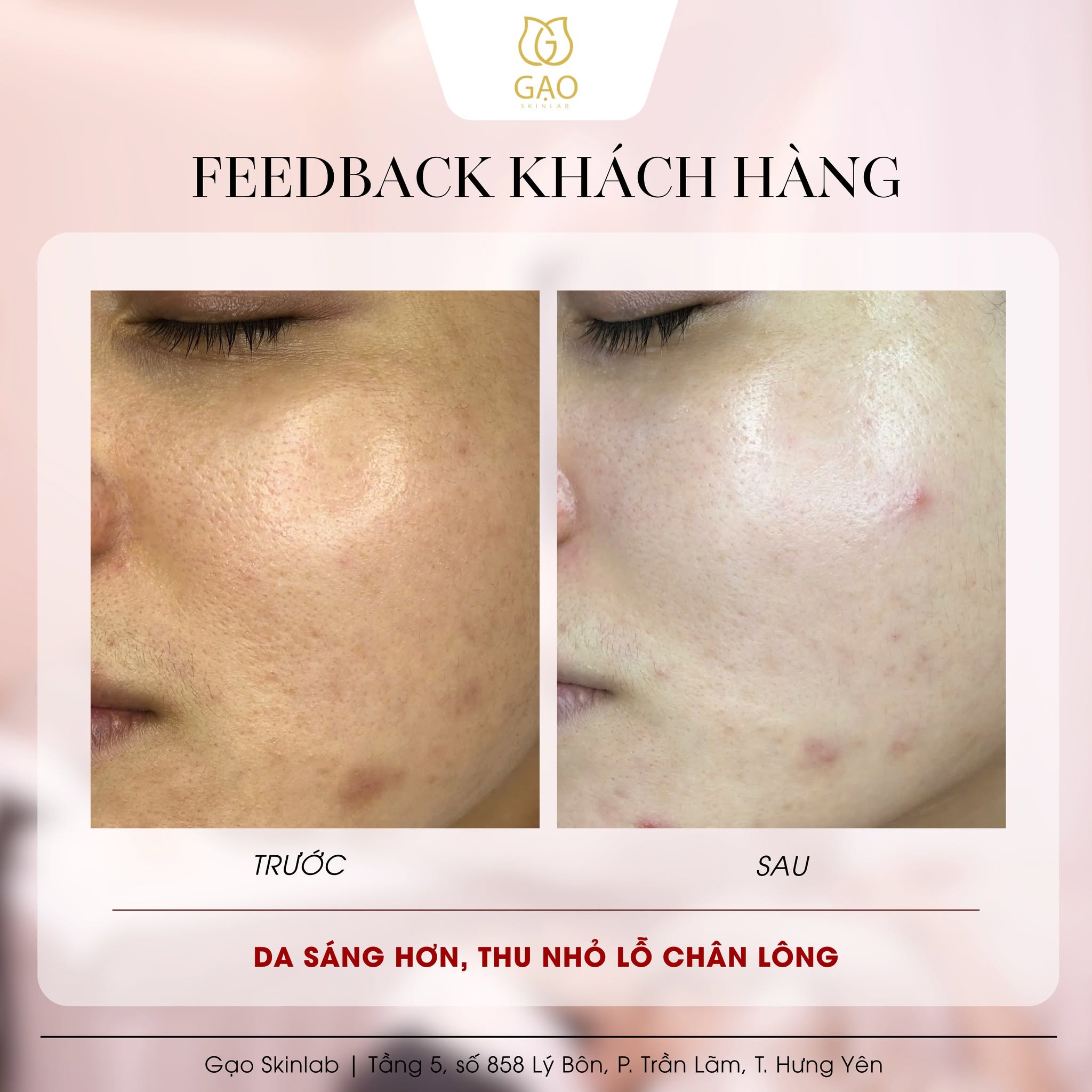 Ảnh ghép trước – sau vùng má của Gạo Skinlab, tiêu đề Feedback khách hàng: bên trái ghi Trước, bên phải ghi Sau; dòng chữ dưới ảnh: Da sáng hơn, thu nhỏ lỗ chân lông.