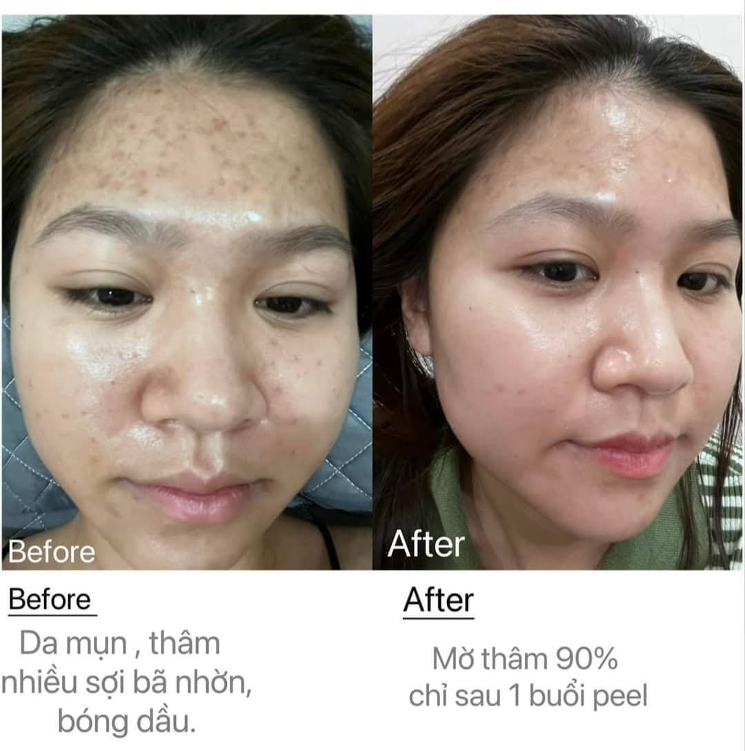 Ảnh ghép chính diện mặt: bên trái ghi Before, trán và má có nhiều chấm thâm, da bóng dầu; bên phải ghi After, da đều màu hơn; chữ dưới ảnh ghi kết quả sau 1 buổi peel.