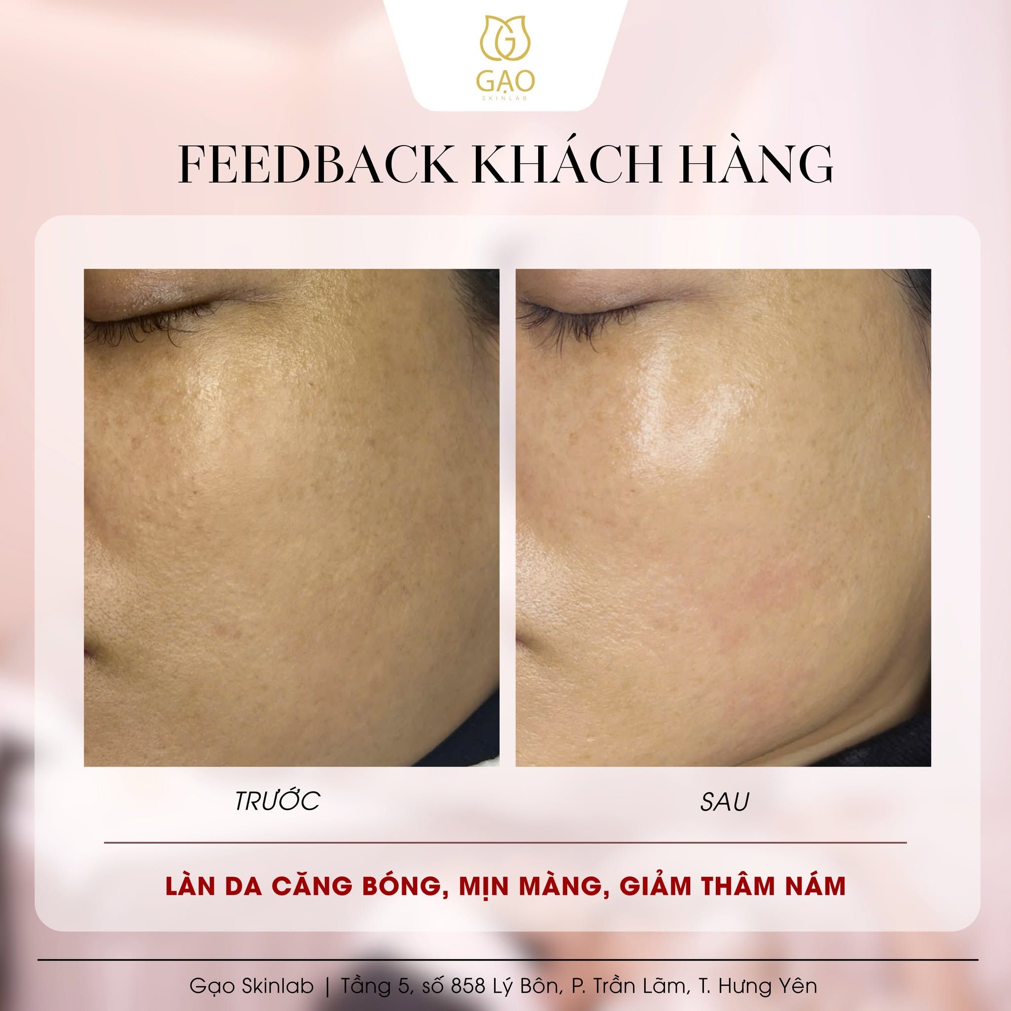Ảnh ghép trước – sau vùng má của Gạo Skinlab, tiêu đề Feedback khách hàng: bên trái ghi Trước, bên phải ghi Sau; dòng chữ dưới ảnh: Làn da căng bóng, mịn màng, giảm thâm nám.