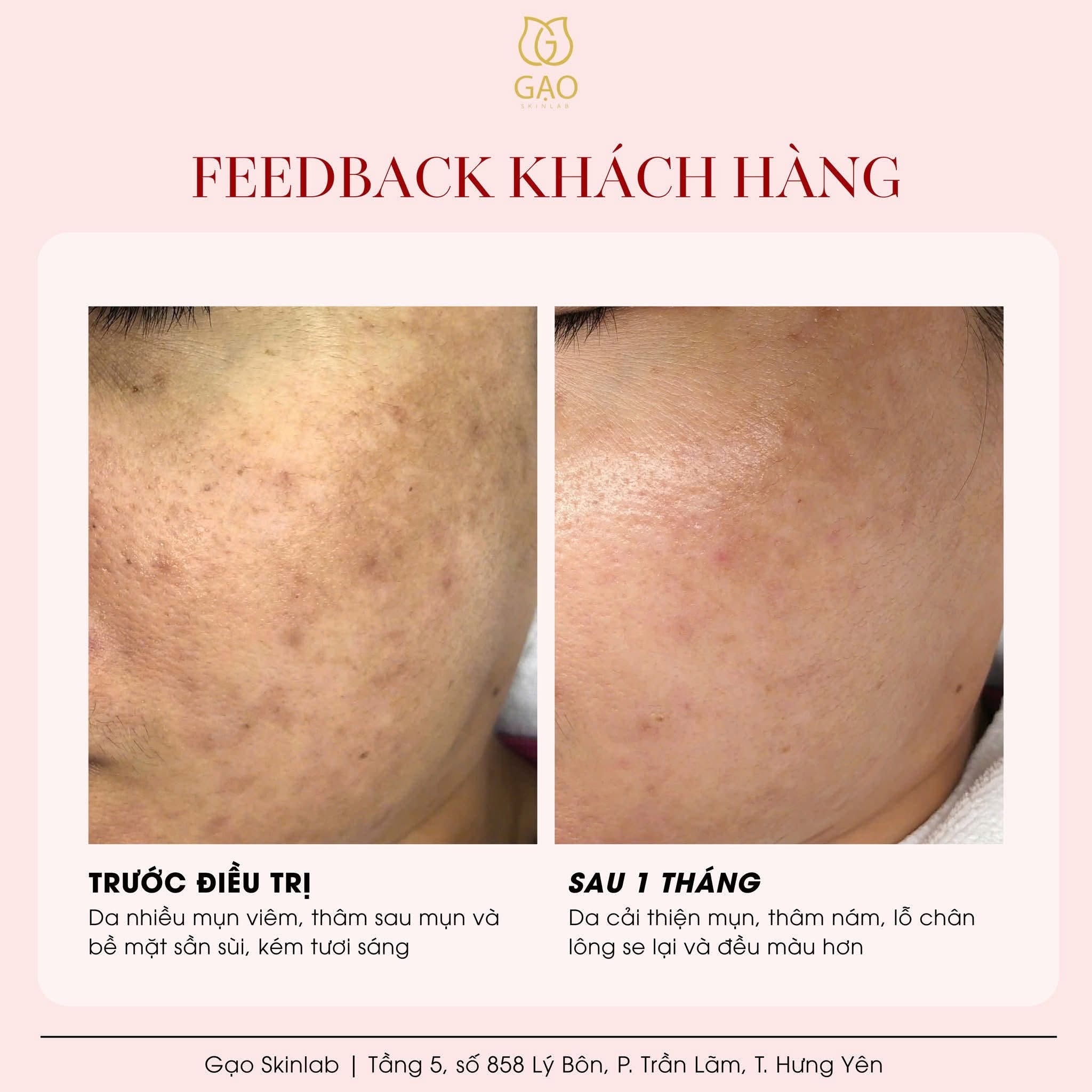 Ảnh ghép trước – sau của Gạo Skinlab, góc má cùng một khách: bên trái ghi Trước điều trị, da nhiều mụn viêm và thâm; bên phải ghi Sau 1 tháng, da đều màu, mịn hơn.