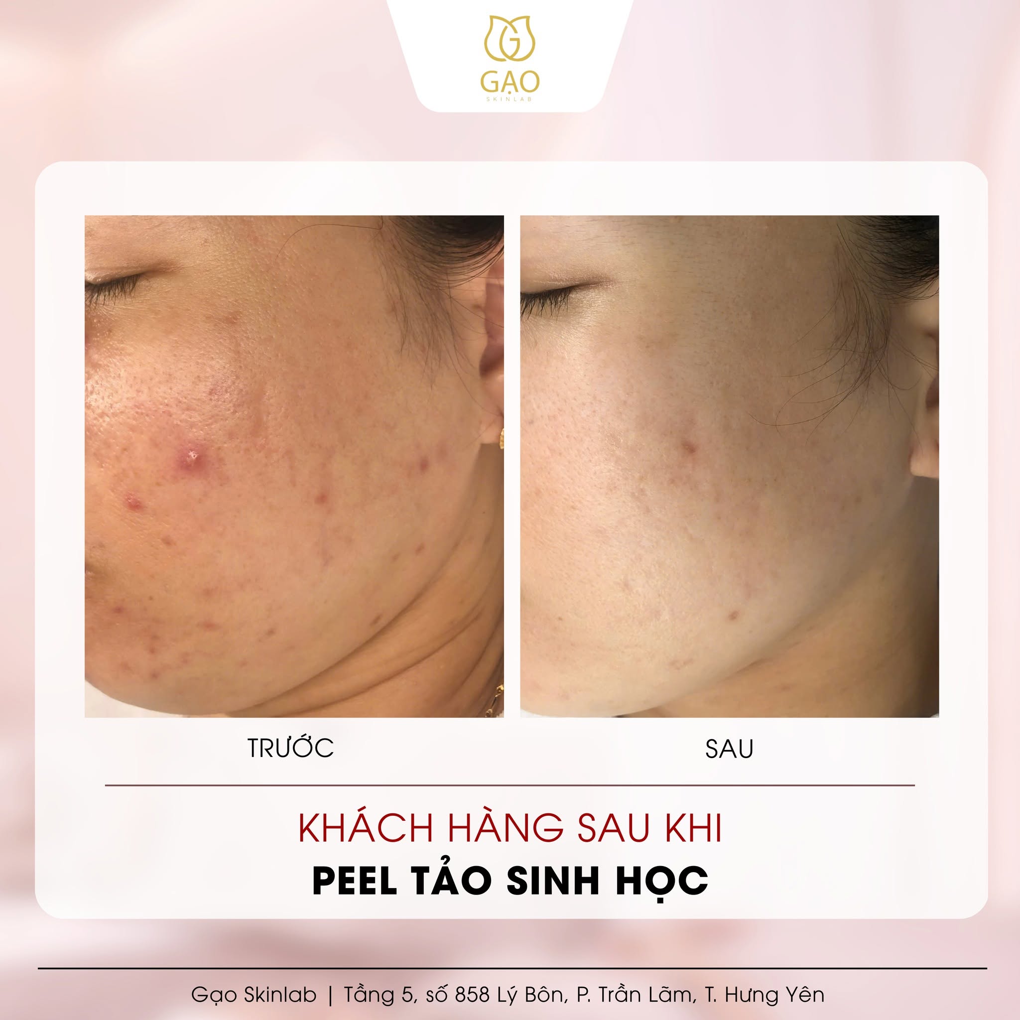 Ảnh ghép trước – sau vùng má của Gạo Skinlab: bên trái ghi Trước, da có mụn viêm; bên phải ghi Sau; dòng chữ dưới ảnh: Khách hàng sau khi peel tảo sinh học.