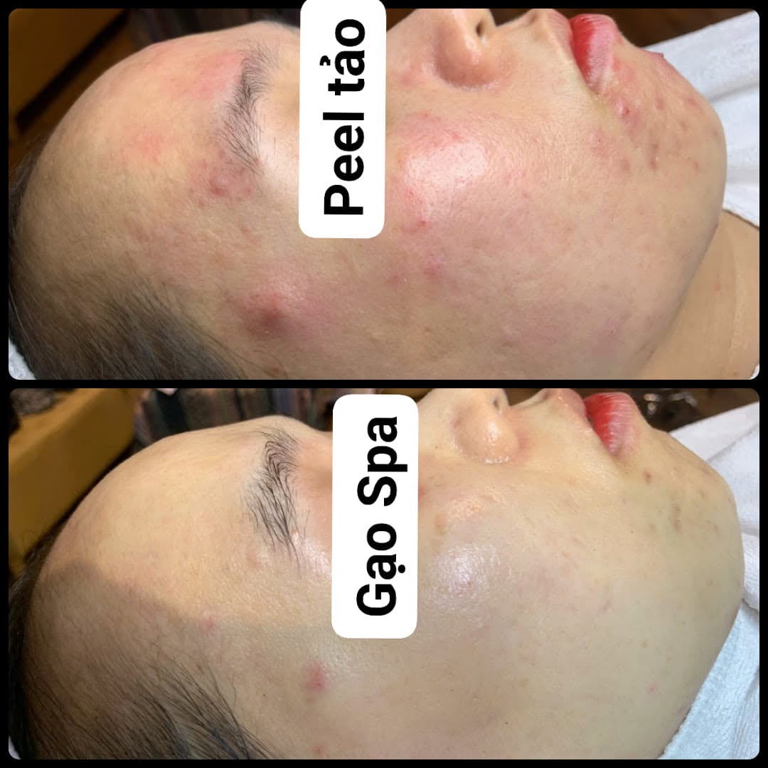 Ảnh ghép góc nghiêng mặt: ảnh trên có nhãn Peel tảo, má và cằm đỏ, có mụn viêm; ảnh dưới có nhãn Gạo Spa, nền da dịu hơn.