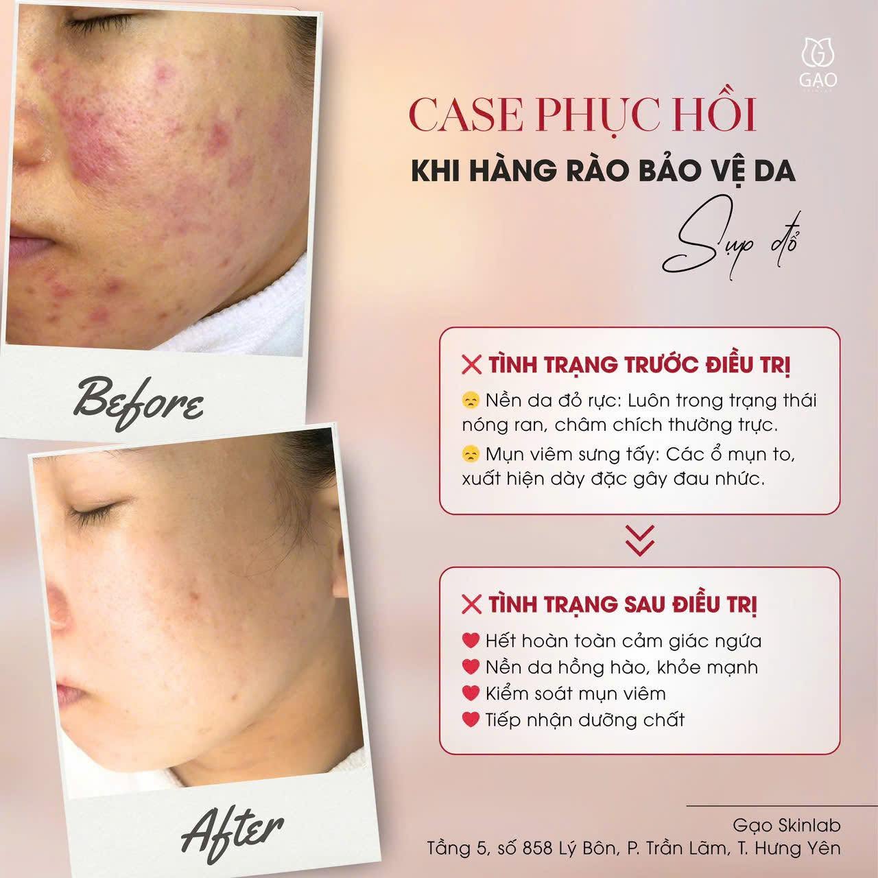 Ảnh ghép của Gạo Skinlab: ảnh trên ghi Before, má đỏ và nhiều mụn viêm; ảnh dưới ghi After, nền da dịu và đều màu hơn; bên phải là hai khung chữ mô tả tình trạng trước và sau.