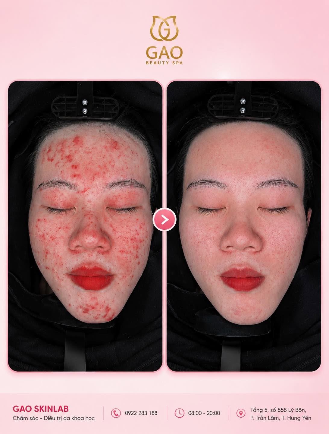 Ảnh ghép toàn mặt có logo Gạo: bên trái là da trước, nhiều nốt đỏ trên trán, má và cằm; mũi tên ở giữa; bên phải là da sau, nền da đều và dịu hơn.